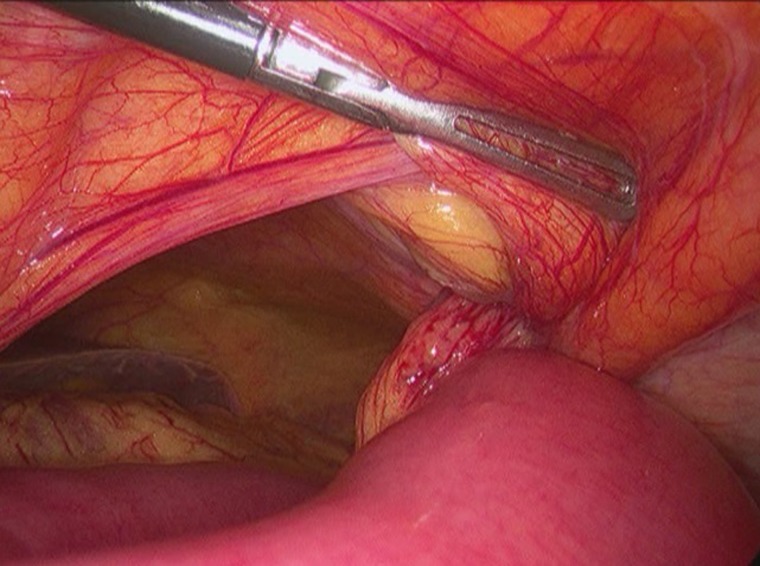 Laparoscopic Approach For A Spontaneous Posterior Rectus Sheath Hernia