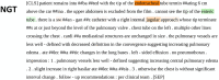 Example of “sequence classification explainer” from PubMedBERT. This figure demonstrates the process of “tokenization,” an automatic process that occurs after unprocessed text is introduced to the model. Words represented by the pretrained model’s “vocabulary” are maintained in their entirety, while those not in the model vocabulary are broken down into fragments that do exist in the vocabulary. These fragments are annotated with preceding “##.” Though the fragments do not hold real meaning, the model learns what combinations of the fragments mean through training in context of the text despite absence of these terms in the model’s vocabulary. Words are highlighted and color-coded per their positive (green), neutral (white), or negative (red) impact on the given task. The resulting saliency map provides insight and context for the model’s probability output. Highlighted annotation of certain words indicates that the model provided attention over a certain threshold to those words before providing an output. BERT = bidirectional encoder representations from transformers, NGT = enterogastric tube.