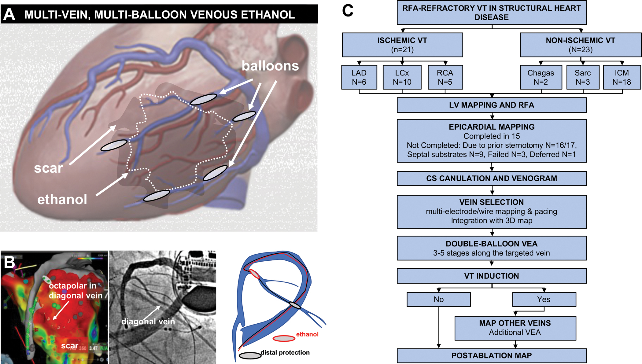 Substrate Ablation By Multi-vein, Multi-balloon Coronary Venous Ethanol 