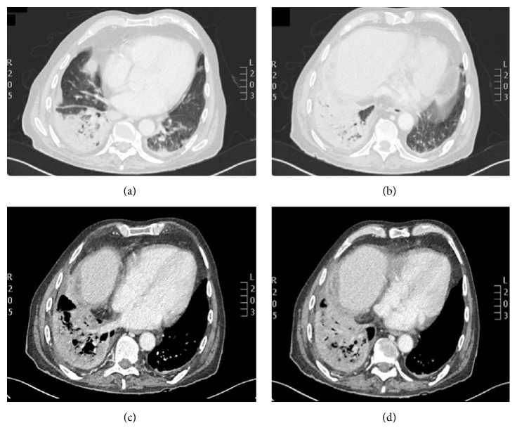 Community-Acquired Pneumonia and Empyema Caused by Citrobacter koseri ...