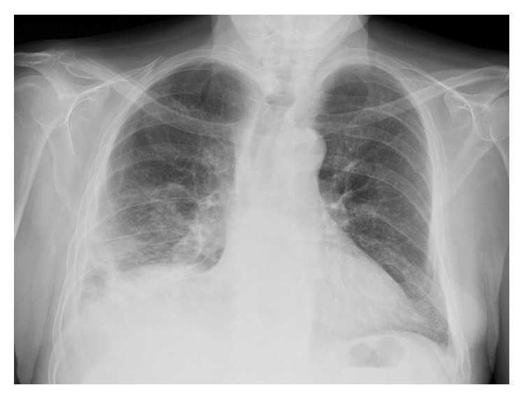 Community-Acquired Pneumonia and Empyema Caused by Citrobacter koseri ...