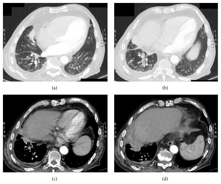 Community-Acquired Pneumonia and Empyema Caused by Citrobacter koseri ...