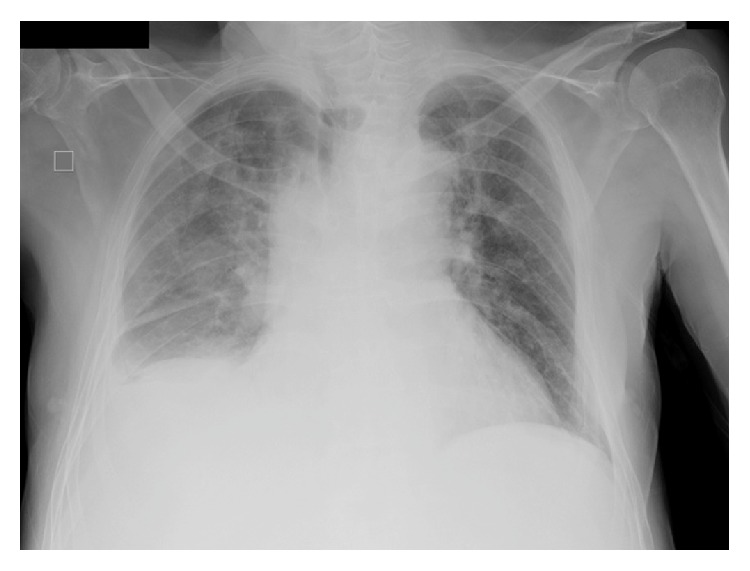 Community-Acquired Pneumonia and Empyema Caused by Citrobacter koseri ...