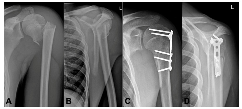 Plate Fixation for Irreducible Proximal Humeral Fractures in Children ...