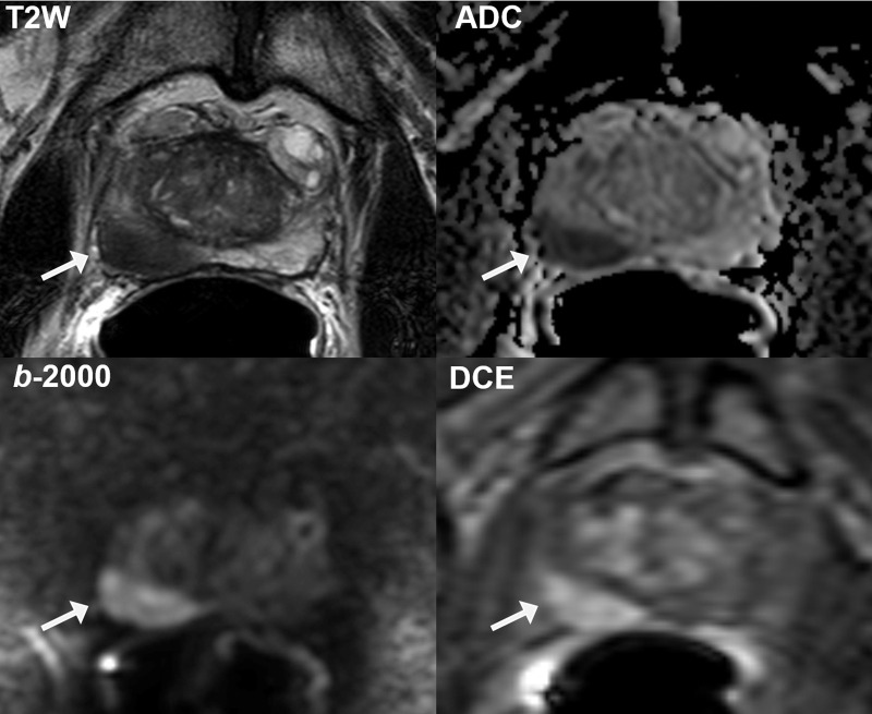 Representative multiparametric MRI scans obtained in 72-year-old African American man with serum prostate-specific antigen concentration of 7.32 ng/mL show large Prostate Imaging Reporting and Data System (version 2) category 5 lesion (arrow) in right midbase peripheral zone (volume, 2.3 mL; index lesion burden, 0.07). The lesion is well visualized on T2-weighted (T2W) image, apparent diffusion coefficient (ADC) map, high b-value (2000 sec/mm2) diffusion-weighted image (b-2000), and dynamic contrast-enhanced (DCE) image, with grade 3 features suspicious for extraprostatic extension. Targeted biopsy revealed Gleason grade 4+3 tumor (International Society of Urological Pathology grade group 3). Final histopathologic findings revealed this to be the only location of malignancy, with final Gleason grade 4+3 tumor (International Society of Urological Pathology grade group 3) encompassing 20% of right prostatic lobe and no evidence of extraprostatic extension or seminal vesicle invasion at pathologic examination.