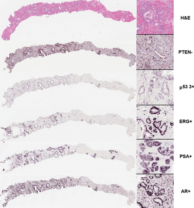 Representative immunohistochemical stains from MRI and transrectal US–targeted biopsy core of index lesion. Hematoxylin-eosin (H&E) stain shows Gleason grade 3+4 (International Society of Urological Pathology grade group 2) prostate adenocarcinoma involving approximately one-third of core length. Immunohistochemistry revealed focal loss of phosphatase and tensin homolog (PTEN) expression in part of tumor and 3+ nuclear staining intensity of p53. ETS-related gene (ERG), prostate-specific antigen (PSA), and androgen receptor (AR) were all positive in tumor regions. Images scanned at × 40 magnification.