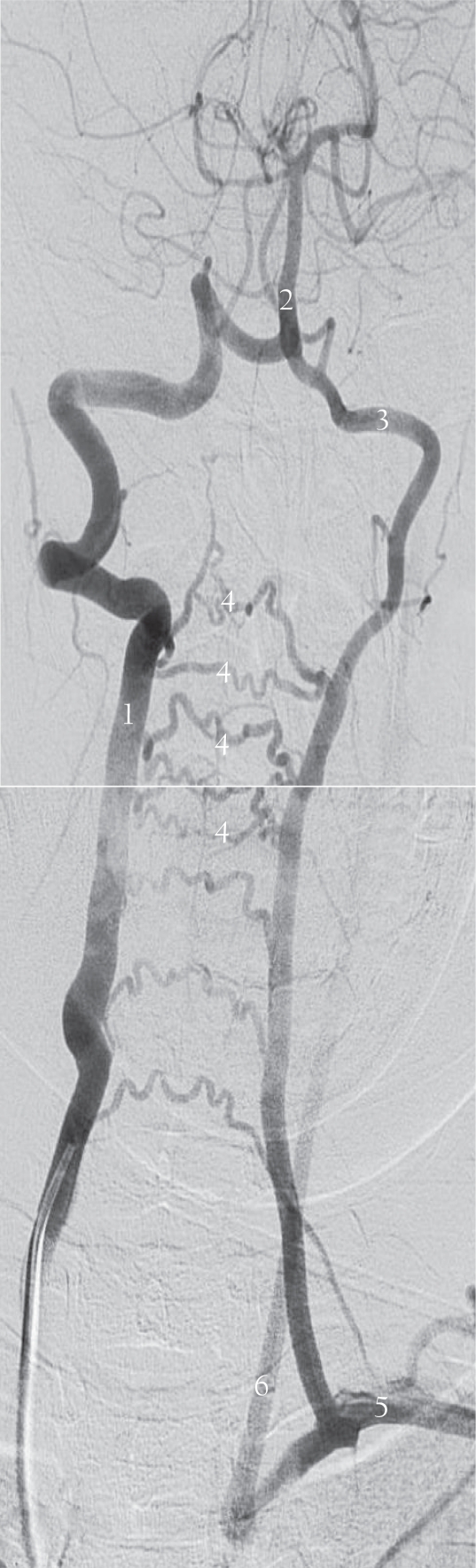Congenital Subclavian Steal Associated with Atresia of a Left ...