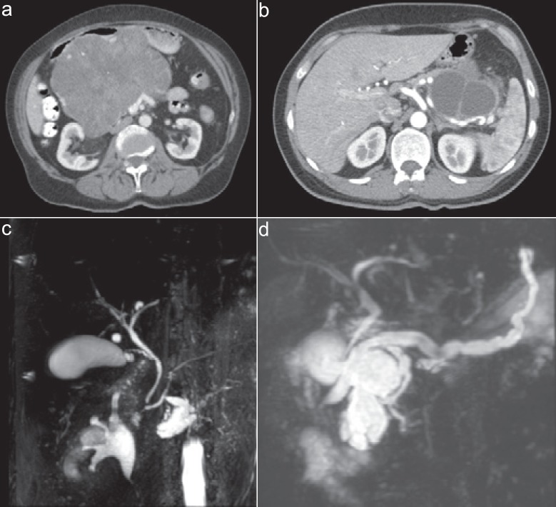 Pancreatic Cystic Neoplasms: Different Types, Different Management, New ...