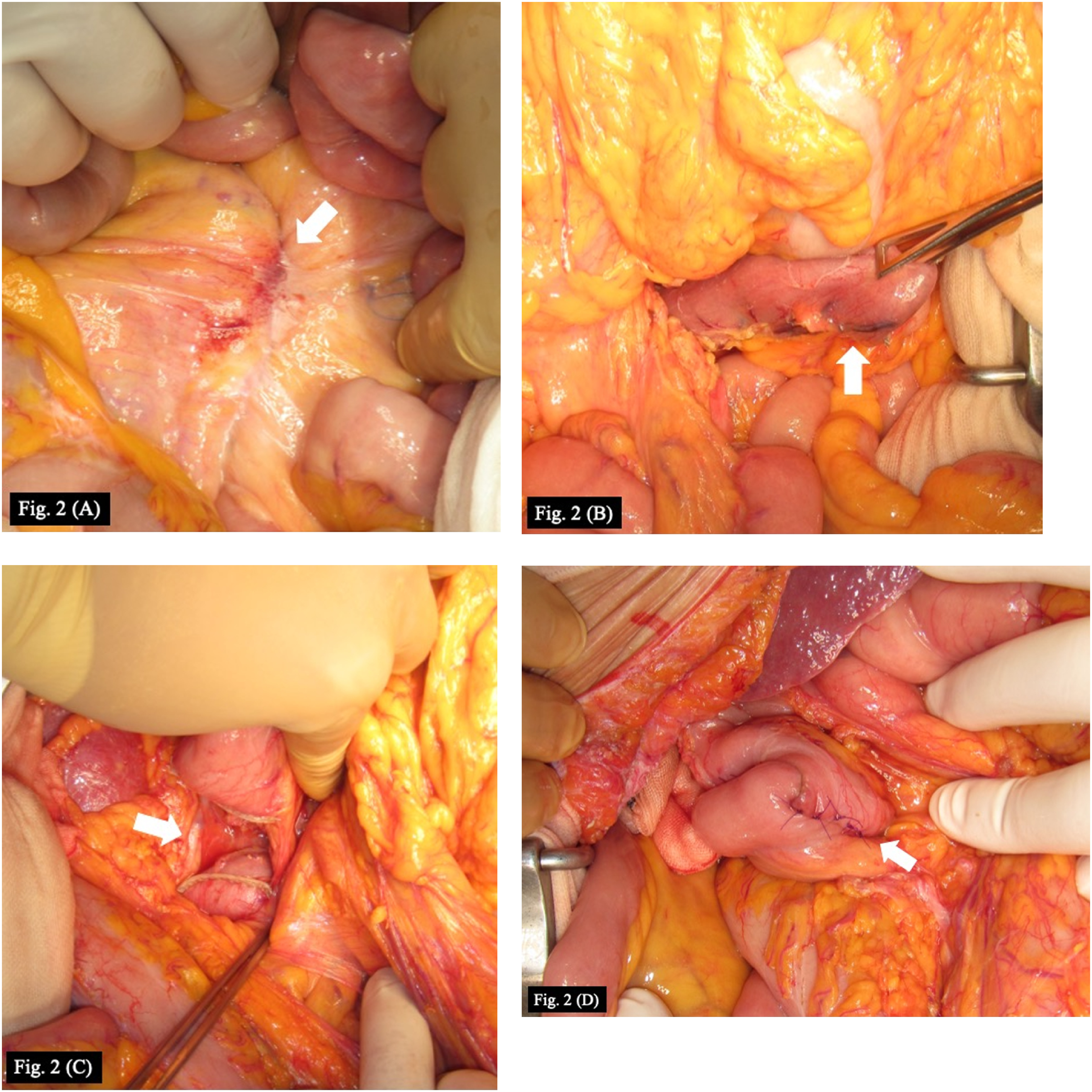 Fig. 2 Operative steps of enteric isolation and anastomosis (case 5). (A) Fistula between the prosthetic graft and duodenum, which formed a mass (arrow). (B) Resection of the jejunum. (C) Resection of the duodenum. (D) Side-to-side anastomosis of the duodenum and jejunum.