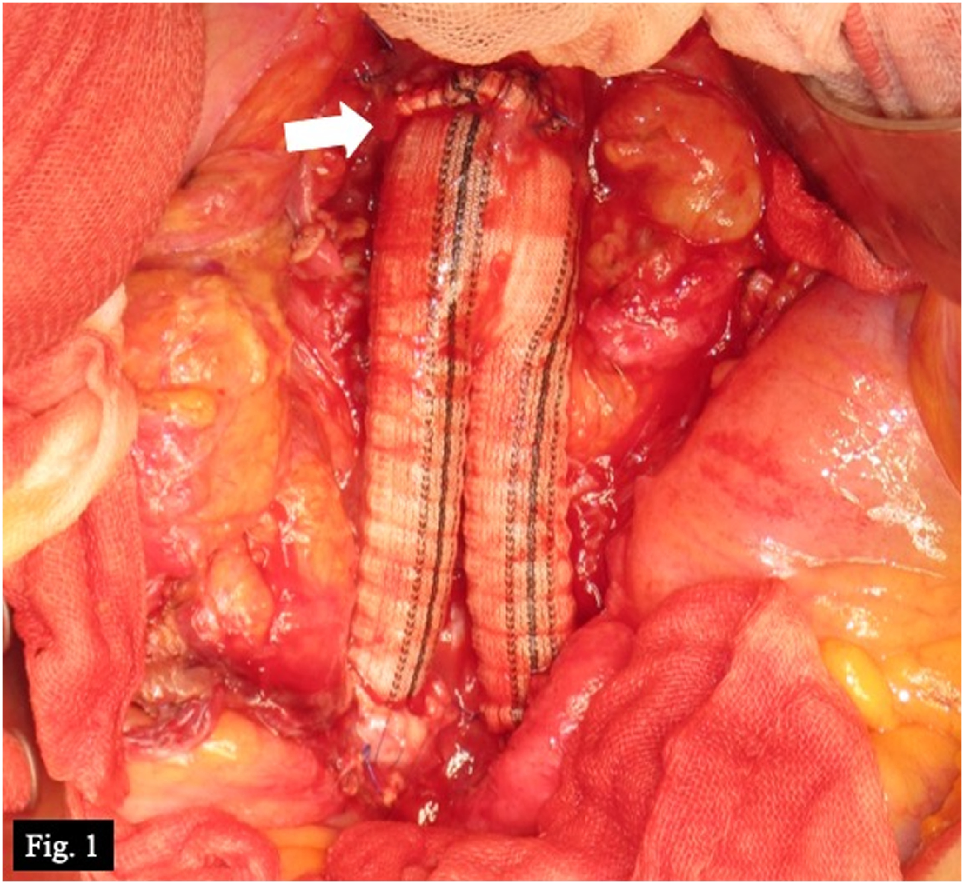 Fig. 1 Operative procedure of in situ reconstruction with a rifampicin-soaked graft (case 5). Central (arrow) and peripheral anastomoses.