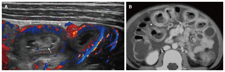 Abdominal ultrasonography of the pediatric gastrointestinal tract - PMC