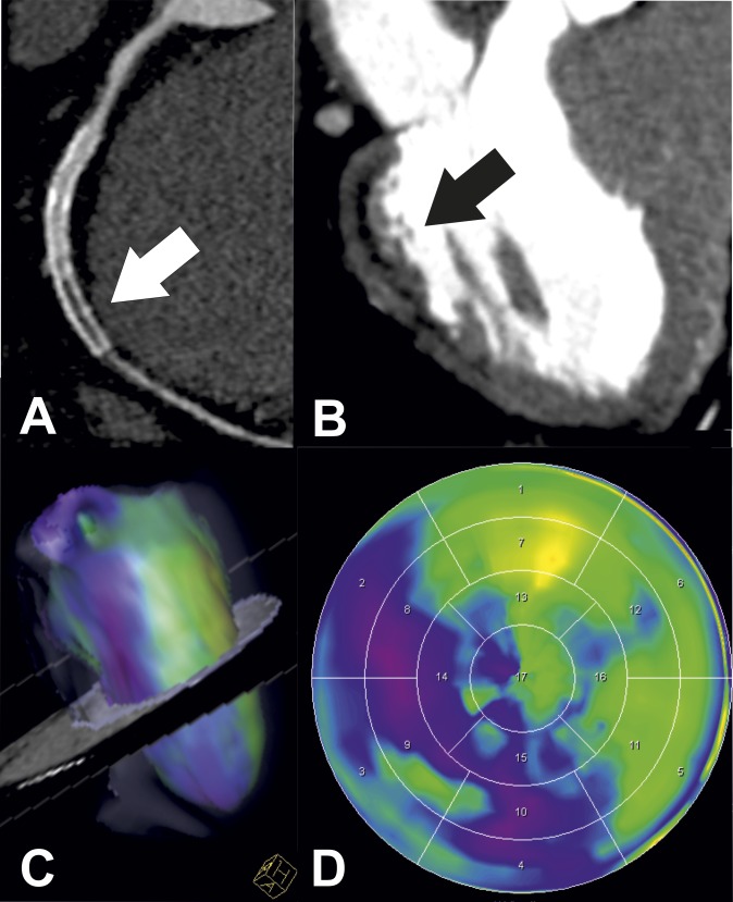 Cardiac Ct For Myocardial Ischaemia Detection And Characterization 