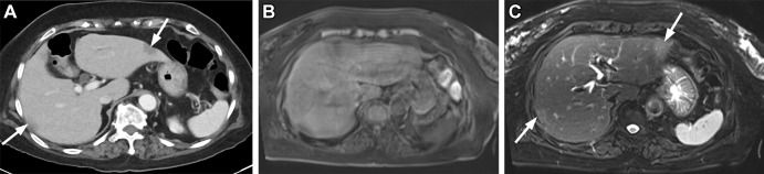 Images in a 96-year-old woman with acute abdominal pain. (A) Axial contrast-enhanced CT scan of the abdomen shows two low-attenuation lesions (arrows) in segment II of left lobe and segment V and/or VI of the right lobe of liver. (B) Initially acquired axial conventional breath-hold T1-weighted gradient-echo MRI scan shows avidly enhancing lesions in both lobes. Image shows significant motion artifacts, limiting accurate lesion characterization. (C) T2-weighted fat-saturated MRI scan acquired using a commercially available gated navigator sequence (prospective acquisition correction technique [PACE, Siemens]) helps mitigate motion artifacts and delineate the T2 intermediate character of the two lesions (arrows).