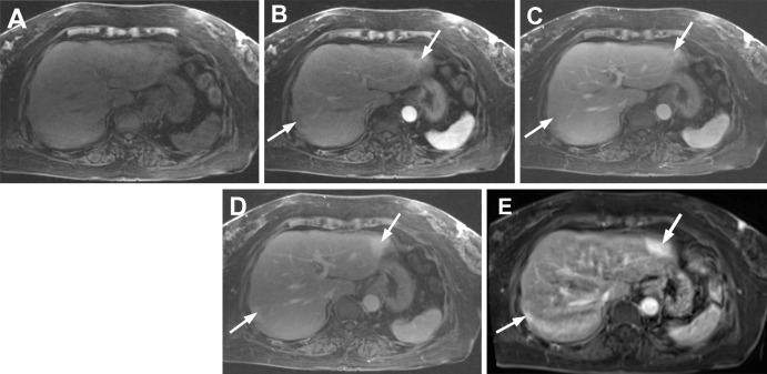 Axial free-breathing dynamic postcontrast images (golden-angle radial sparse parallel [GRASP]) in the same patient as in Figure 1, devoid of motion artifacts. Images obtained (A) before contrast material administration and (B) 30 seconds, (C) 60 seconds, and (D) 190 seconds after gadolinium-based contrast material administration. Contrast-enhanced images demonstrate peripheral complete rim of heterogeneous late arterial phase enhancement (B), thus excluding hemangioma, with progressive centripetal contrast material fill-in on the portal venous (C) and delayed phase images (D). (E) Conventional breath-hold contrast-enhanced axial T1-weighted MRI scan in delayed phase was also acquired after GRASP (the patient was injected only once with 6.1-mL dose of intravenous gadobutrol). Image shows avidly enhancing lesions in both lobes of liver. When compared to GRASP images, this breath-hold image shows significant motion artifacts limiting accurate lesion characterization. Arrows in B–E indicate lesions.