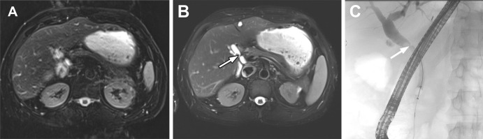 Images obtained after liver transplant in a 53-year-old man with a history of chronic hepatitis B and hepatocellular carcinoma. (A) Conventional axial T2-weighted fat-saturated MRI scan shows mild motion and phase-related artifacts causing blurring of the region of the biliary anastomoses. (B) Deep learning–based T2-weighted MRI scan shows significantly better anatomic clarity and reduced artifact. The accelerated image was acquired with approximately one-third of data collection in a single breath hold, resulting in better image quality with reduced blurring artifacts. Mild biliary dilatation proximal to the surgical anastomoses and a small calculus (arrow)are also clearly delineated. (C) Image from endoscopic retrograde cholangiopancreatography shows a filling defect at the anastomoses correlating with the calculus seen at MRI (arrow).