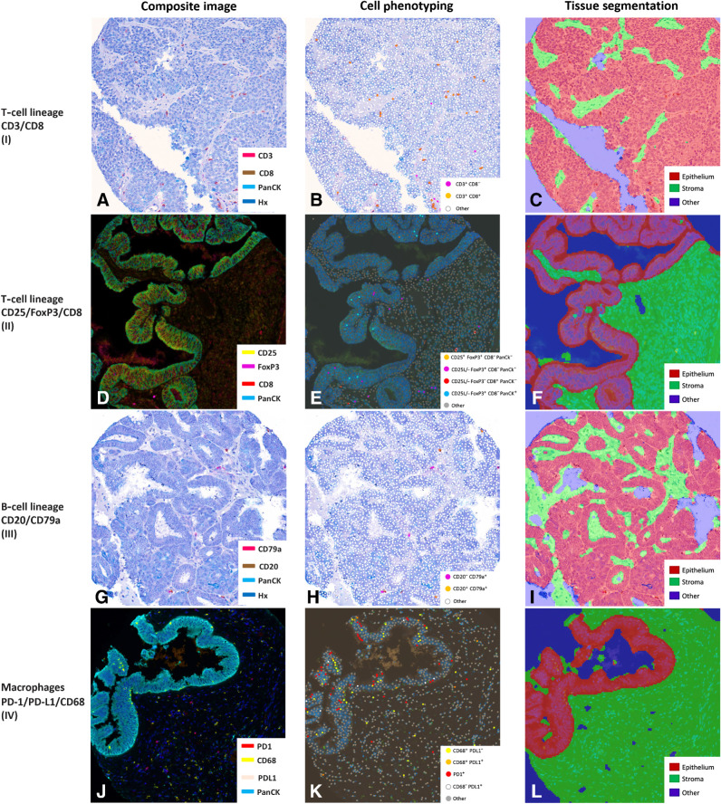 Figure 2. Multicolor IHC. A–L, Representative images of multicolor IHC and multispectral imaging of TILs for each immune panel, including images of applied automated tissue segmentation into tissue compartments.