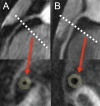MR angiograms (top row) of the right coronary arteries in two persons
living with HIV (PLWH) show location of cross-section (dotted lines) of
coronary vessel wall image (bottom row) and the corresponding automatic wall
thickness measurement. (A) Image from 50-year-old male PLWH with increased
coronary vessel wall thickness of 1.5 mm and grade 1 diastolic dysfunction.
(B) Image from 52-year-old male PLWH with coronary vessel wall thickness of
1.2 mm and normal diastolic function.