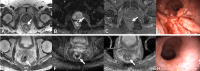 (A–D) Images in a participant incorrectly categorized as having
MRI clinical complete response (cCR) (false positive). (A) Axial T2-weighted
image shows fibrosis (arrow). (B) Diffusion-weighted image shows absent
restricted diffusion (arrow). (C) Apparent diffusion coefficient map shows
low signal intensity (arrow). (D) Representative image from restaging
endoscopy shows obvious residual tumor, which was confirmed at
histopathologic assessment following total mesorectal excision. (E–H)
Images in a participant incorrectly categorized as having MRI incomplete
clinical response (false negative). (E) Axial T2-weighted image shows
intermediate signal intensity (arrow). (F) Diffusion-weighted image shows
restricted diffusion at a high b value (b = 800 sec/mm²) (arrow). (G)
Apparent diffusion coefficient map shows low signal intensity (arrow). (H)
Representative image from restaging endoscopy shows cCR. The participant was
placed on watch-and-wait surveillance and had sustained cCR over 5 years of
follow-up.
