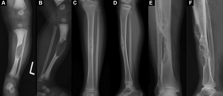 Osteofibrous dysplasia: a narrative review - PMC