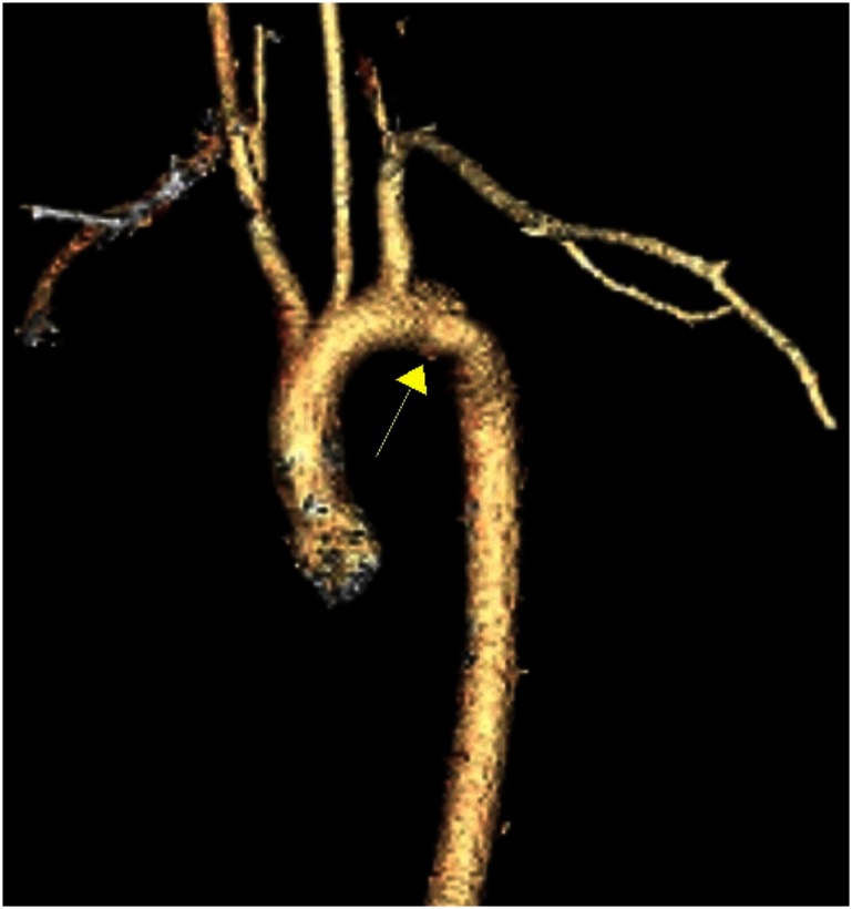 Fig. 1 Pseudoaneurysm at the aortic isthmus.