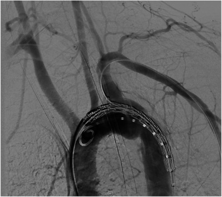 Fig. 3 Arch aortography, showing a grade III injury at the aortic isthmus.