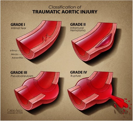 Fig. 2 Classification of traumatic aortic injury. Reprinted from Reference 12 with permission from Azizzadeh A, et al. 