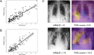 Siamese neural network-based Pulmonary X-Ray Severity (PXS) score is a measure of radiographic pulmonary disease severity in patients with COVID-19. A and B, Scatterplots show, in a 154-patient internal test set (A) and 113-patient external hospital test set (B), the PXS score correlates with the modified Radiographic Assessment of Lung Edema (mRALE) score, a measure of pulmonary disease severity on chest radiographs (p=0.86, P<0.001 and p=0.86, P<0.001, respectively) (linear regression 95% confidence interval shown in the scatterplots). C, Occlusion sensitivity map-based approach shows that the Siamese neural network is focusing on pulmonary opacities. Yellow areas indicate parts of the image important to the neural network.