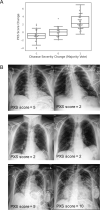 Siamese neural network-based Pulmonary X-Ray Severity (PXS) score can be used to assess longitudinal change in radiographic disease severity over time in COVID-19 patients. A, Boxplot shows the PXS score correlates with majority vote change in pulmonary disease severity (ρ=0.74, P<0.001), where -1, 0, and 1 indicate decreased, unchanged, and increased severity in longitudinal chest radiograph pairs, assigned by three independent raters (2 thoracic radiologists, 1 in-training radiologist). The boxplot boxes indicate the median and interquartile range (IQR), with whiskers extending to points within 1.5 IQRs of the IQR boundaries. B, Examples of PXS score evaluation of longitudinal change in three patients with COVID-19.