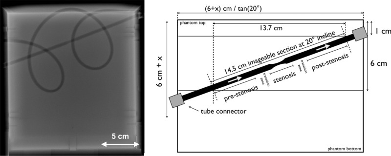 Flow phantom description. Radiograph (left side) shows a linear tube section angled at a 20° incline from left to right. This linear section included a 40% stenosis (ie, a 5- to 3-mm diameter reduction plus subsequent expansion back to 5 mm) over a 3-cm tube length. There is also a curved tubing section that forms two loops. These are intended to be anatomically curved and possess diameter fluctuations with a mean of 5 mm. Schematic (right side) shows the position of stenotic tubing section. Stenotic section and transition zone are not to scale.