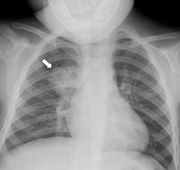 A 4-year-old male with fever and respiratory distress. The frontal chest radiograph shows a round consolidation (arrow) in the medial right upper lung zone which is atypical for pediatric COVID-19 pneumonia. This patient’s round pneumonia was due to bacterial infection.