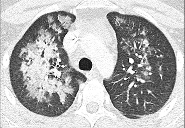 A 16-year-old female who presented with fever, cough, and chest pain. The axial lung window CT image shows bilateral central consolidation and ground-glass opacities, which are atypical CT findings of pediatric COVID-19 pneumonia. This patient’s CT findings are due to biopsy-proven varicella pneumonia.