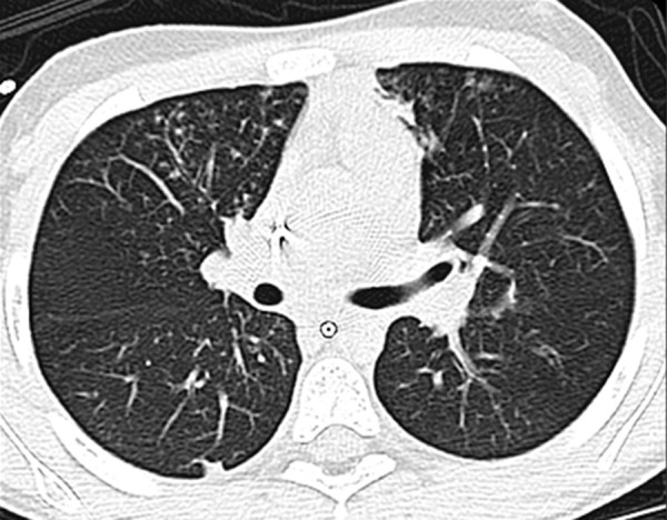 An 8-year-old girl who presented with fever and worsening cough. The axial lung window CT image shows bilateral discrete small nodules in the tree-in-bud pattern in the right middle lobe and lingula, which are atypical CT findings for pediatric COVID-19 pneumonia. This patient’s CT findings are due to a Mycobacterium infection.