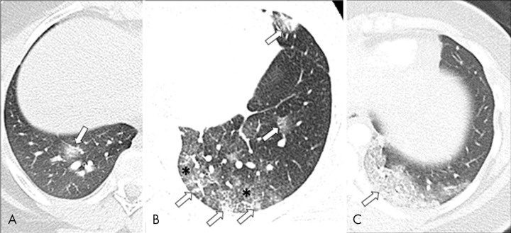 Three different phases (early, progressive, and developed) of COVID-19 pneumonia in three different pediatric patients. A, Early phase of pediatric COVID-19 pneumonia in a 14-year-old female with Hodgkin lymphoma and a positive COVID-19 RT-PCR test who presented with fever and cough. The axial lung window CT image shows a rounded ground-glass opacity (arrow) with a subtle area of central consolidation in keeping with the “halo” sign that is often seen in the early phase of pediatric COVID-19 pneumonia. B, Progressive phase of pediatric COVID-19 pneumonia in a 15-year-old female with traveling history in an endemic area in Europe and a positive COVID-19 RT-PCR test who presented with increasing cough and shortness of breath. The axial lung window CT image demonstrates rounded ground-glass opacities (arrows) with a subtle area of central consolidation. Between these areas, ground-glass opacities (*) start to fill the lung parenchyma. C, Developed phase of pediatric COVID-19 pneumonia in a 16-year-old female with a positive COVID-19 RT-PCR test who presented with severe shortness of breath. The axial lung window CT image shows predominantly confluent consolidation (arrow) in the posterior left lower lobe.