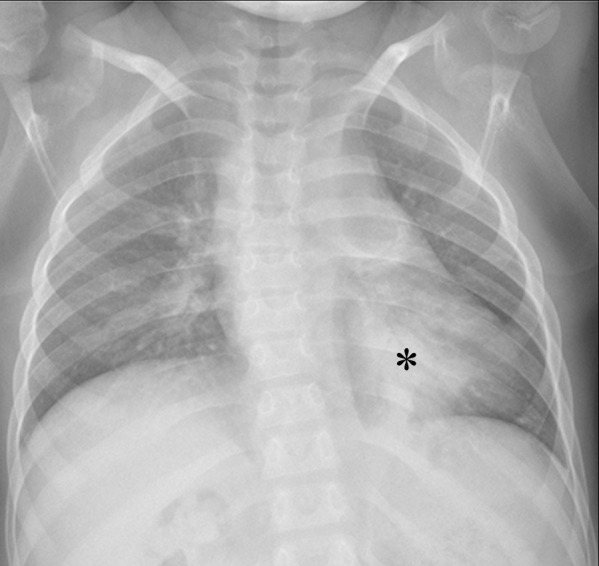 A 9-year-old female with a renal transplant and a positive COVID-19 RT-PCR test who presented with respiratory distress. The frontal chest radiograph shows consolidation (*) in the left lower lobe, which is atypical for pediatric COVID-19 pneumonia.