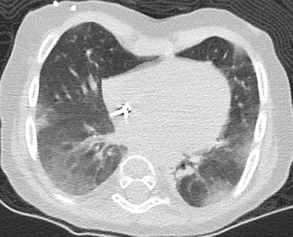 A 21-month-old female with Hurler disease after bone marrow transplant and a positive COVID-19 RT-PCR test who presented with fever and respiratory distress. The axial lung window CT image shows bilateral peripheral and subpleural ground-glass opacities, which are typical CT findings in pediatric COVID-19.