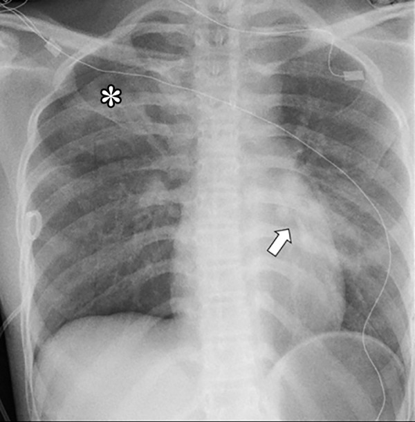 A 15-year-old female with asthma and a positive COVID-19 RT-PCR test who presented with fever and respiratory distress. The frontal chest radiograph shows ground-glass opacities in both peripheral (*) and central (arrow) distribution, which are indeterminate chest radiographic findings of pediatric COVID-19 pneumonia. Also noted is the right apical pneumothorax.