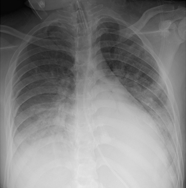 A 16-year-old female with tuberous sclerosis and a positive COVID-19 RT-PCR test who presented with acute hypoxic respiratory distress. The frontal chest radiograph shows bilateral lower-lung zone-predominant consolidation and ground-glass opacities, which are typical chest radiographic findings of pediatric COVID-19 pneumonia. Also noted are the endotracheal tube and nasogastric tube.