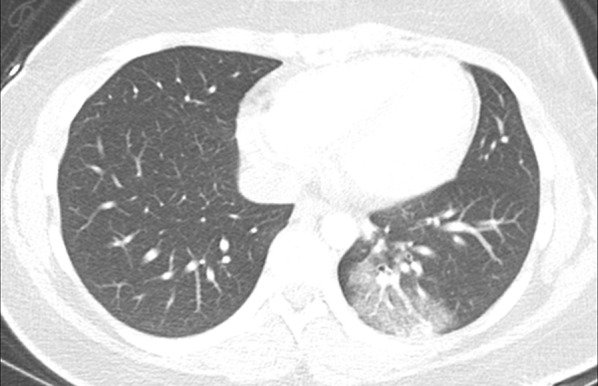 A 16-year-old female with a positive COVID-19 RT-PCR test who presented with shortness of breath. The axial lung window CT image shows ground-glass opacity with a small component of consolidation in the posterior left lower lobe, which are indeterminate CT findings of pediatric COVID-19 pneumonia.