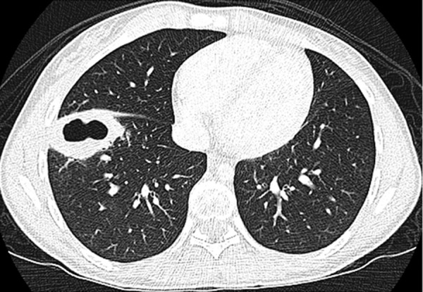 A 16-year-old female who presented with fever and cough. The axial lung window CT image shows a peripherally located lung lesion with cavitation in the right lower lobe, which are atypical CT findings for pediatric COVID-19 pneumonia. This patient’s CT findings are due to a Staphylococcus aureus infection.