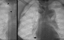 Fluoroscopy images show successful delivery of surfacer device after retrohepatic IVC recanalization