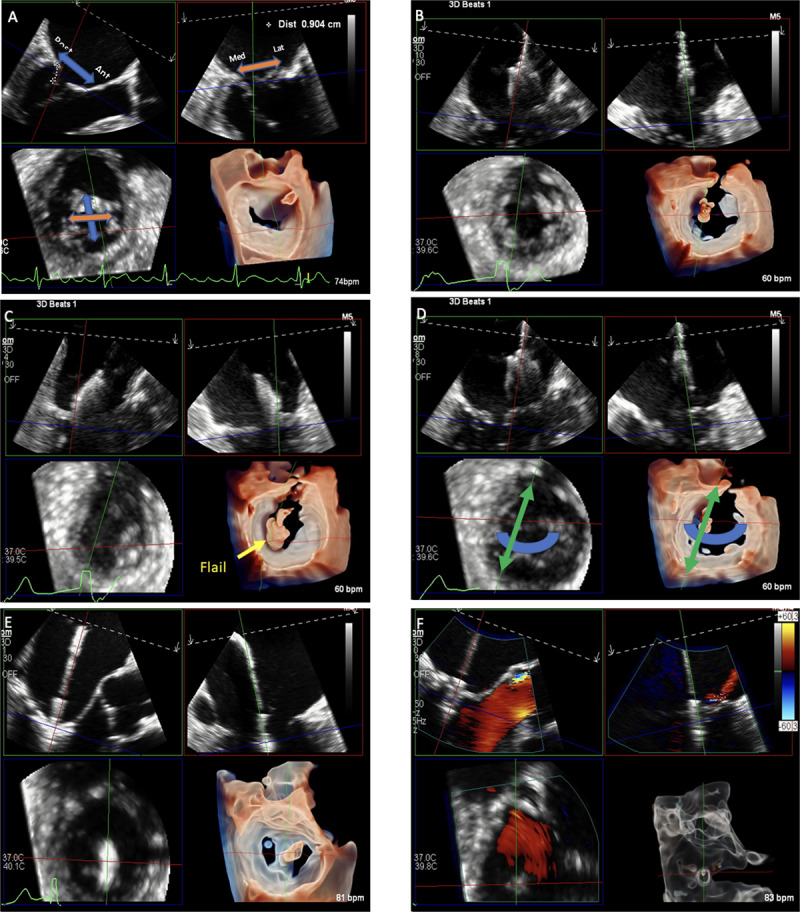 Multiplanar reconstruction of MR using TEE for guidance.