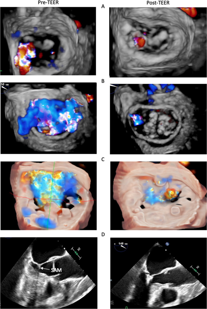 Pre- and post-TEER echocardiography in challenging cases.