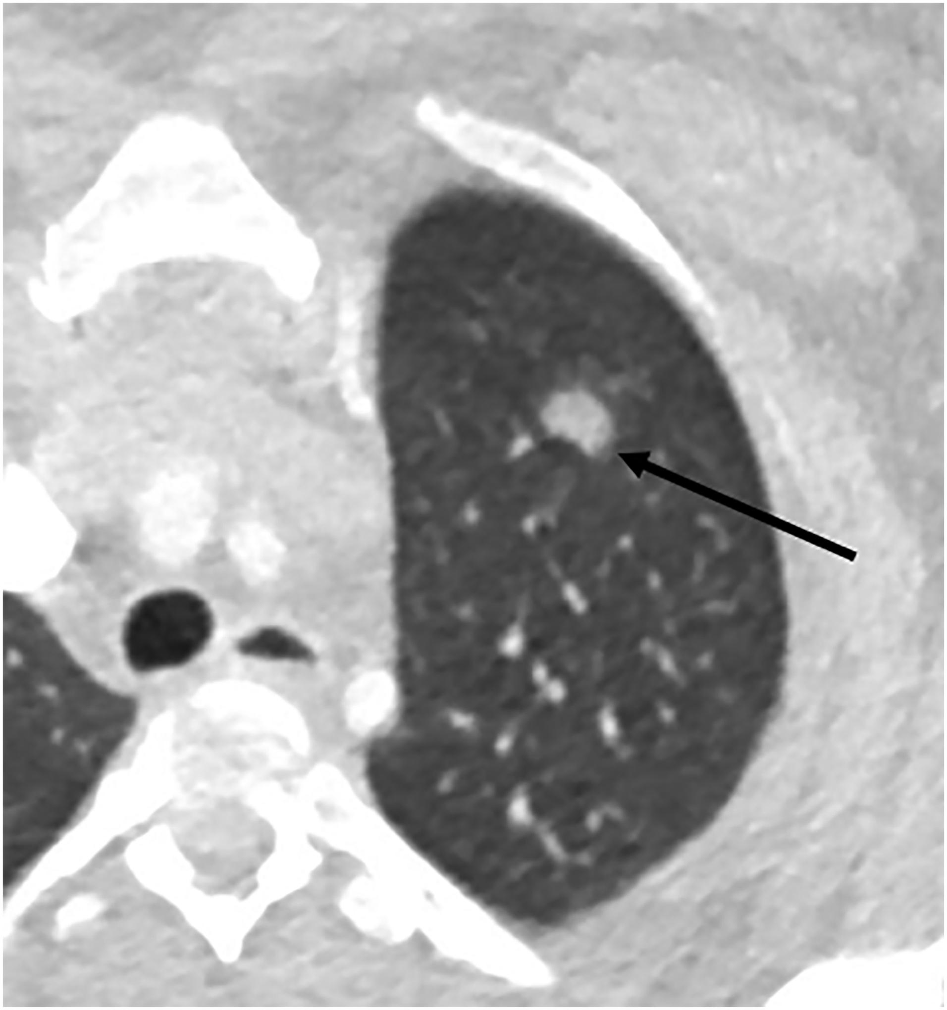 Risk of Malignancy in Incidentally Detected Lung Nodules in Patients ...