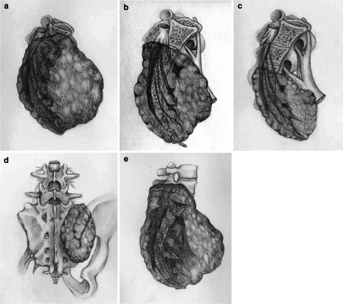 Surgical classification of different types of en bloc resection for ...