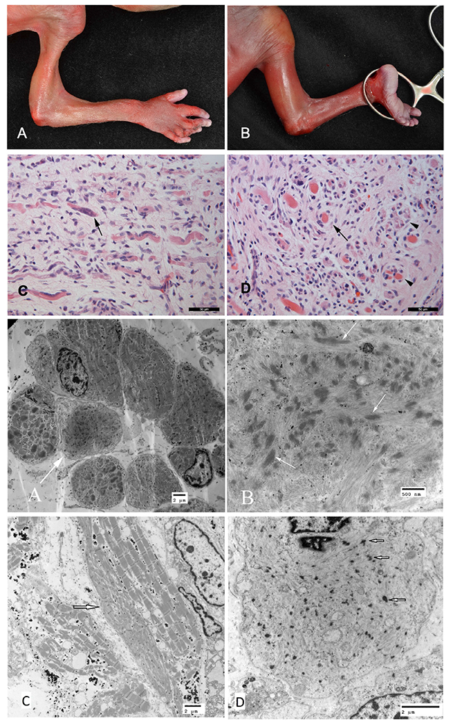 Fetal Akinesia Deformation Sequence Syndrome Associated With Recessive 