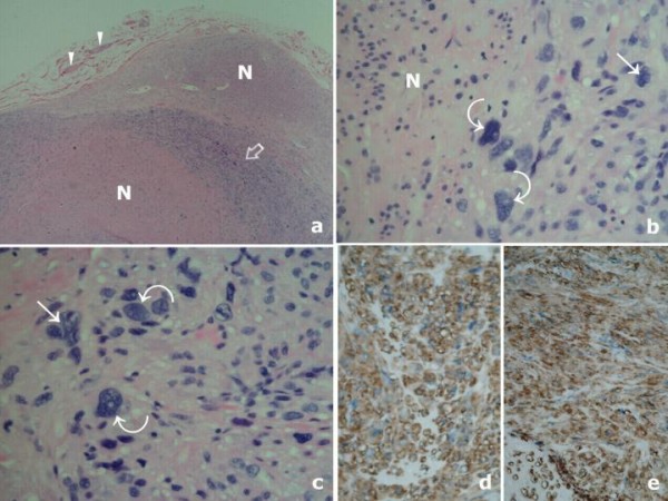 Symplastic scrotal leiomyoma: a case report - PMC