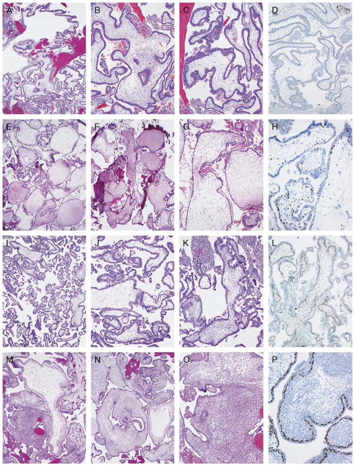 Diagnostic Reproducibility of Hydatidiform Moles: Ancillary Techniques ...