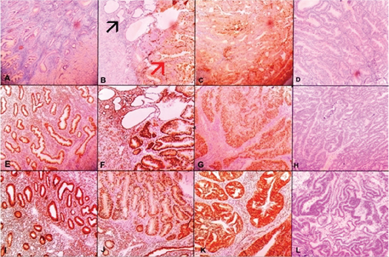 The Expression Of Stanniocalcin-1, Estrogen Receptor And Progesterone 