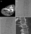CT-guided percutaneous drainage to spondylodiscitis