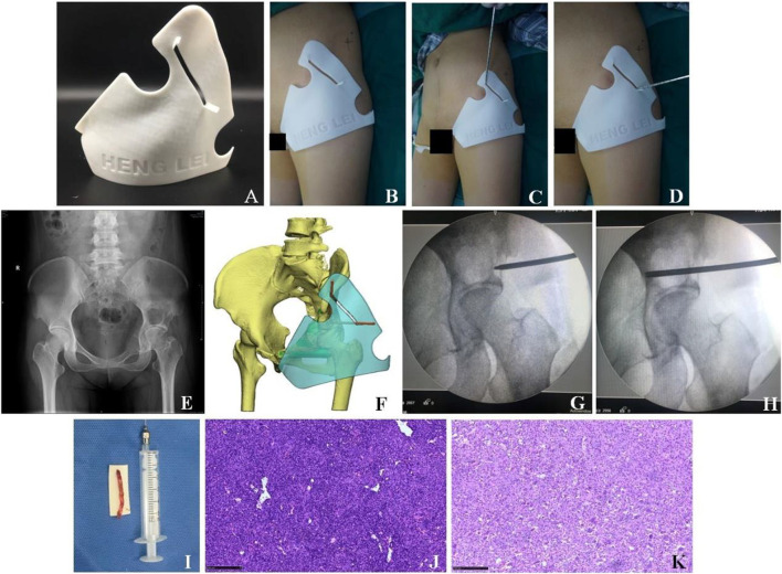 Application Of 3D Printing Individualized Guide Plates In Percutaneous ...